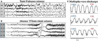 Combined Effects of Feedforward Inhibition and Excitation in Thalamocortical Circuit on the Transitions of Epileptic Seizures